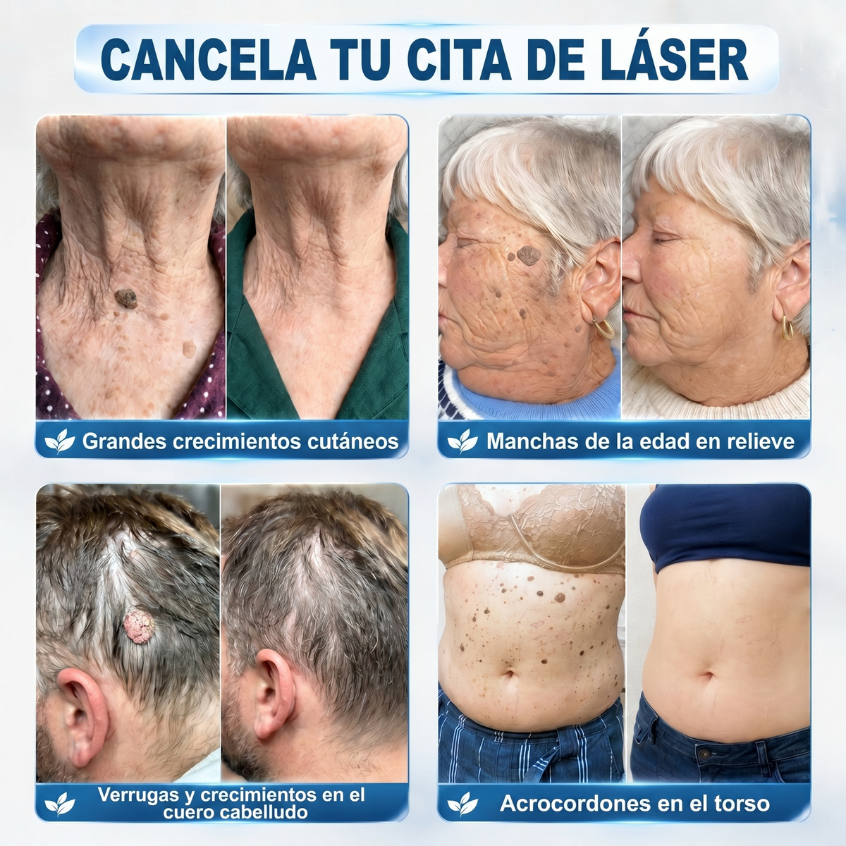 🥇🎉Loja Oficial da Picdo® | Removedor de Verrugas e Manchas em 7 Dias – Roll-on Sem Dor e Sem Cicatrizes