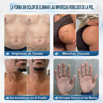 🥇🎉Loja Oficial da Picdo® | Removedor de Verrugas e Manchas em 7 Dias – Roll-on Sem Dor e Sem Cicatrizes