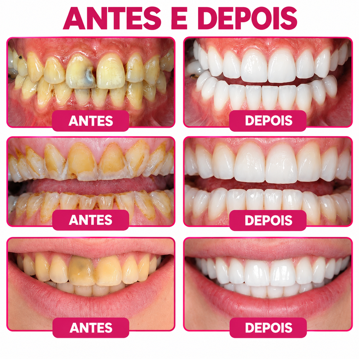 🇵🇹 Loja Oficial |🦷🎄Rolimey® DenPerm – Gel natural de preenchimento do esmalte dentário para o tratamento de cáries