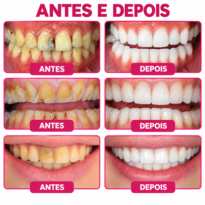 🇵🇹 Loja Oficial |🦷🎄Rolimey® DenPerm – Gel natural de preenchimento do esmalte dentário para o tratamento de cáries