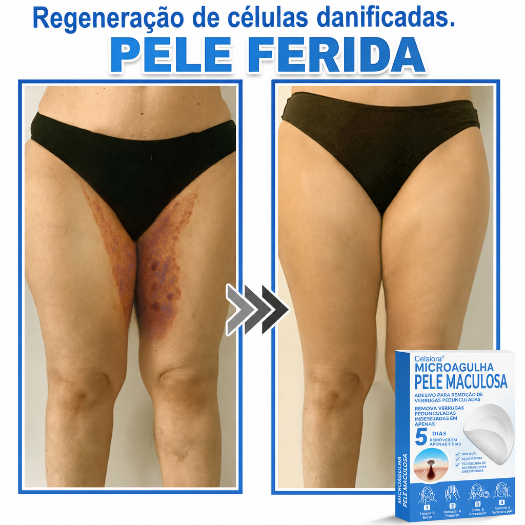 🏆Celsiora® Adesivos 2 em 1 de Microagulhas e Hidrocoloide | Removedor de Sinais Elevados🍒🍒