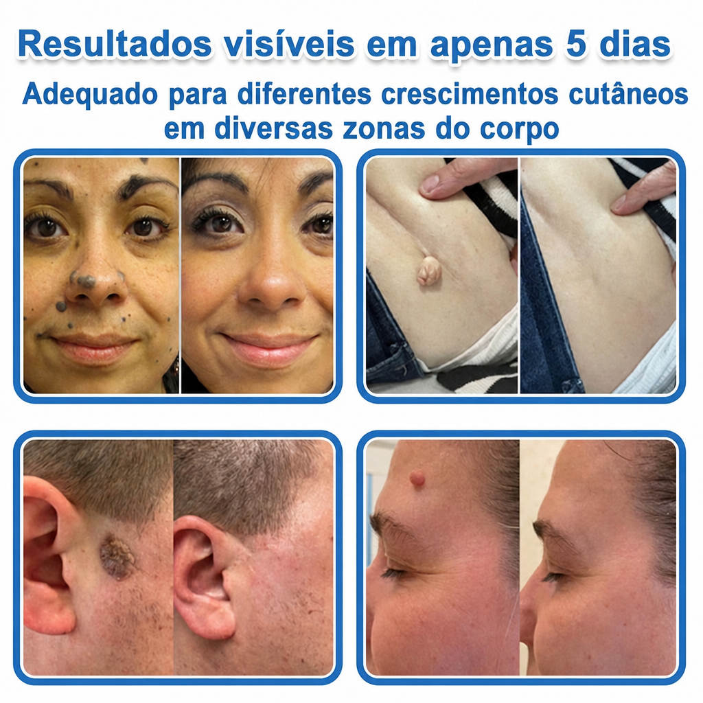 🏆Celsiora® Adesivos 2 em 1 de Microagulhas e Hidrocoloide | Removedor de Sinais Elevados🍒🍒