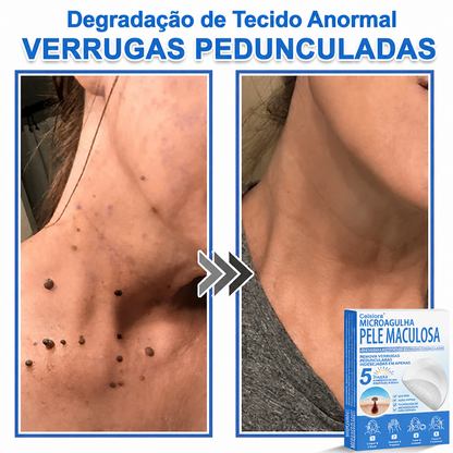 🏆Celsiora® Adesivos 2 em 1 de Microagulhas e Hidrocoloide | Removedor de Sinais Elevados🍒🍒