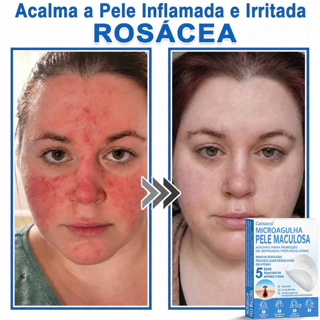 🏆Celsiora® Adesivos 2 em 1 de Microagulhas e Hidrocoloide | Removedor de Sinais Elevados🍒🍒