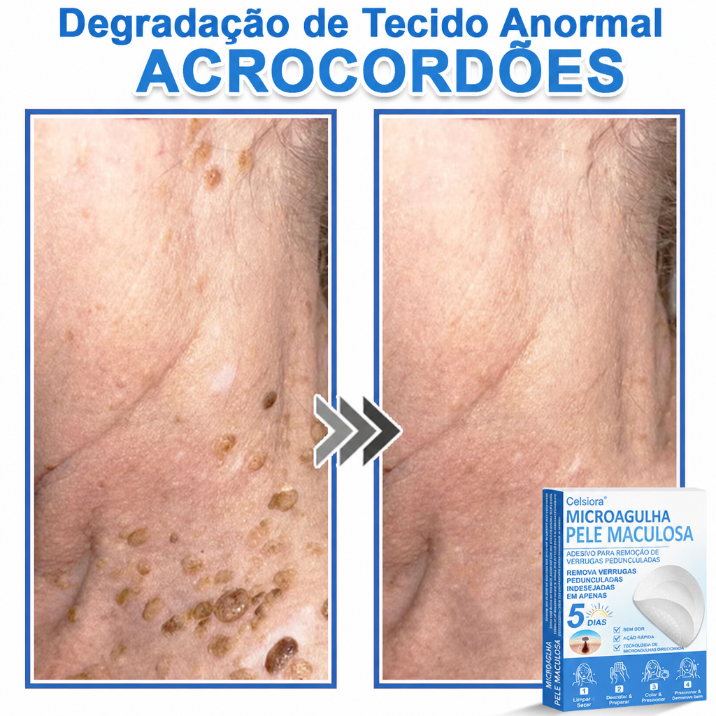 🏆Celsiora® Adesivos 2 em 1 de Microagulhas e Hidrocoloide | Removedor de Sinais Elevados🍒🍒