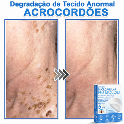 🏆Celsiora® Adesivos 2 em 1 de Microagulhas e Hidrocoloide | Removedor de Sinais Elevados🍒🍒