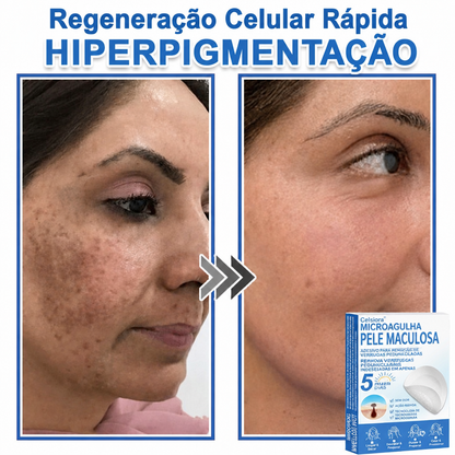 🏆Celsiora® Adesivos 2 em 1 de Microagulhas e Hidrocoloide | Removedor de Sinais Elevados🍒🍒