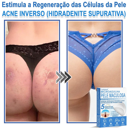 🏆Celsiora® Adesivos 2 em 1 de Microagulhas e Hidrocoloide | Removedor de Sinais Elevados🍒🍒