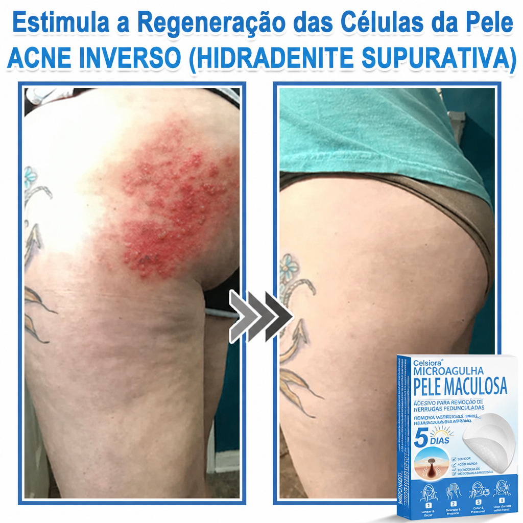 🏆Celsiora® Adesivos 2 em 1 de Microagulhas e Hidrocoloide | Removedor de Sinais Elevados🍒🍒