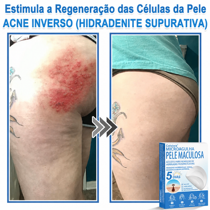 🏆Celsiora® Adesivos 2 em 1 de Microagulhas e Hidrocoloide | Removedor de Sinais Elevados🍒🍒